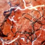 BCA - Morgellons Fibres