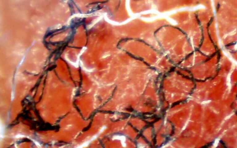 BCA - Morgellons Fibres