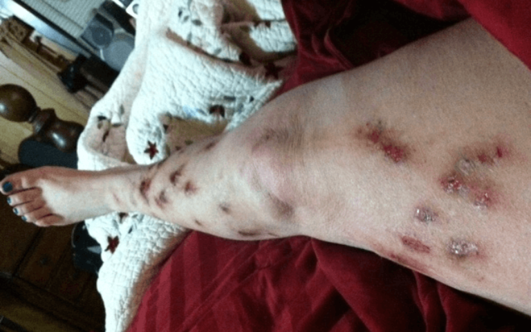 5 Myths About Morgellons Disease