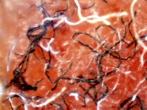 Why is Morgellons Often Misdiagnosed as Delusional Parasitosis?