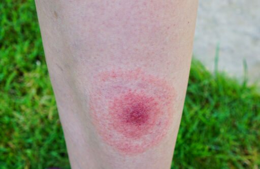 How To Identify the Lyme Disease Bullseye Rash On Different Skin Types