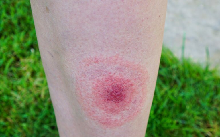 How To Identify the Lyme Disease Bullseye Rash On Different Skin Types